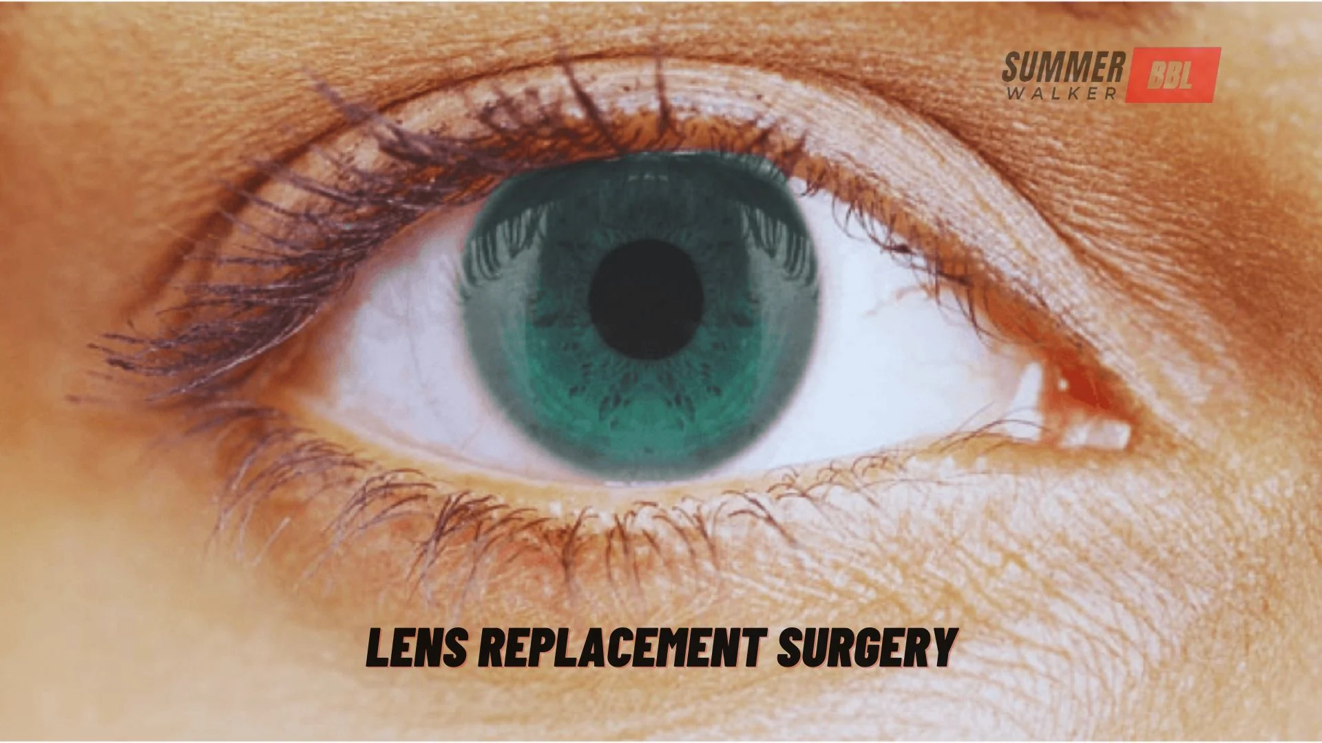 Lens Replacement Surgery